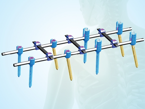 Spinal internal fixation type Ⅳ
